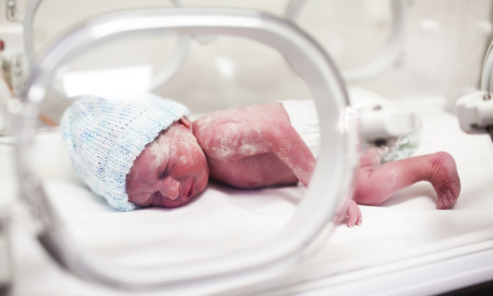 Недоношенные дети роды. Неонатальный сепсис у новорожденных. Новорожденные дети. Недоношенный новорожденный.
