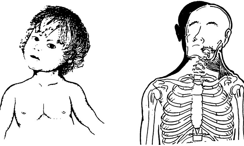 Врожденная мышечная кривошея. Врожденная костная кривошея. Врожденная мышечная кривошея рентген. Кривошея у новорожденных схема. Костные форма врожденной кривошеи.